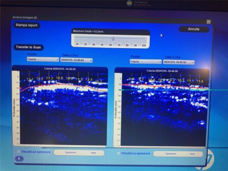 Riduzione del grasso con la dieta personalizzata